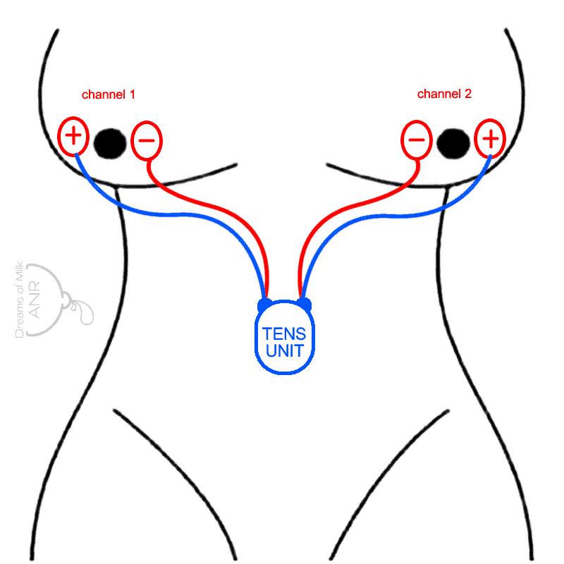 Using a TENS Unit to Stimulate Lactation